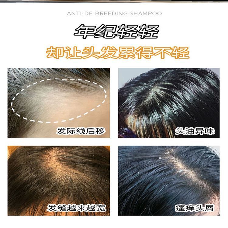 泰国生姜洗发水防脱生发发际线粉不伤头皮头发增长液加快生长